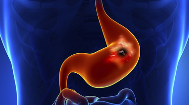 stomach_cancer.jpg