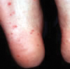 Symptoms of Hand, Food and Mouth Disease