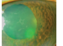 A glaucoma diagnosis will help identify the type of glaucoma the patient has. 