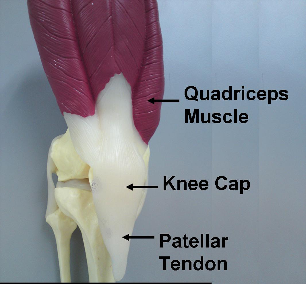 Patellar Tendinopathy