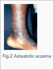 Skin problems like asteatotic eczema occurs when the oil content of the skin decreases with age.