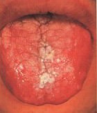 The elderly may be susceptible to certain types of mouth sores or mouth ulcers.