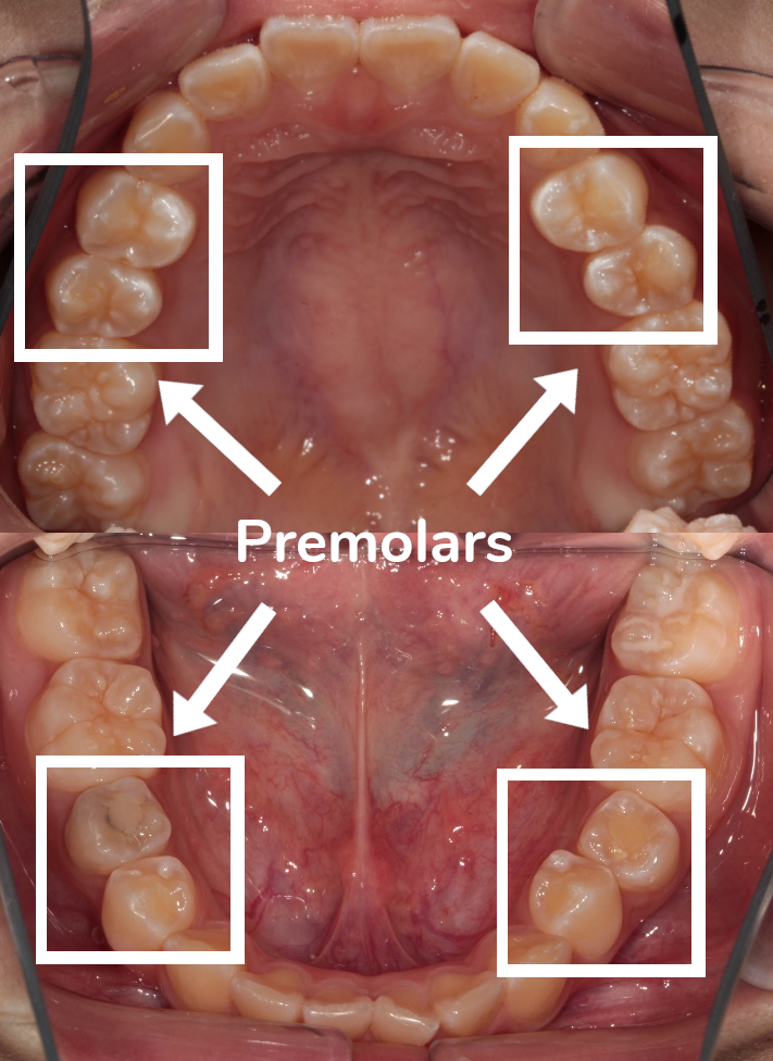 Pre molar on sale