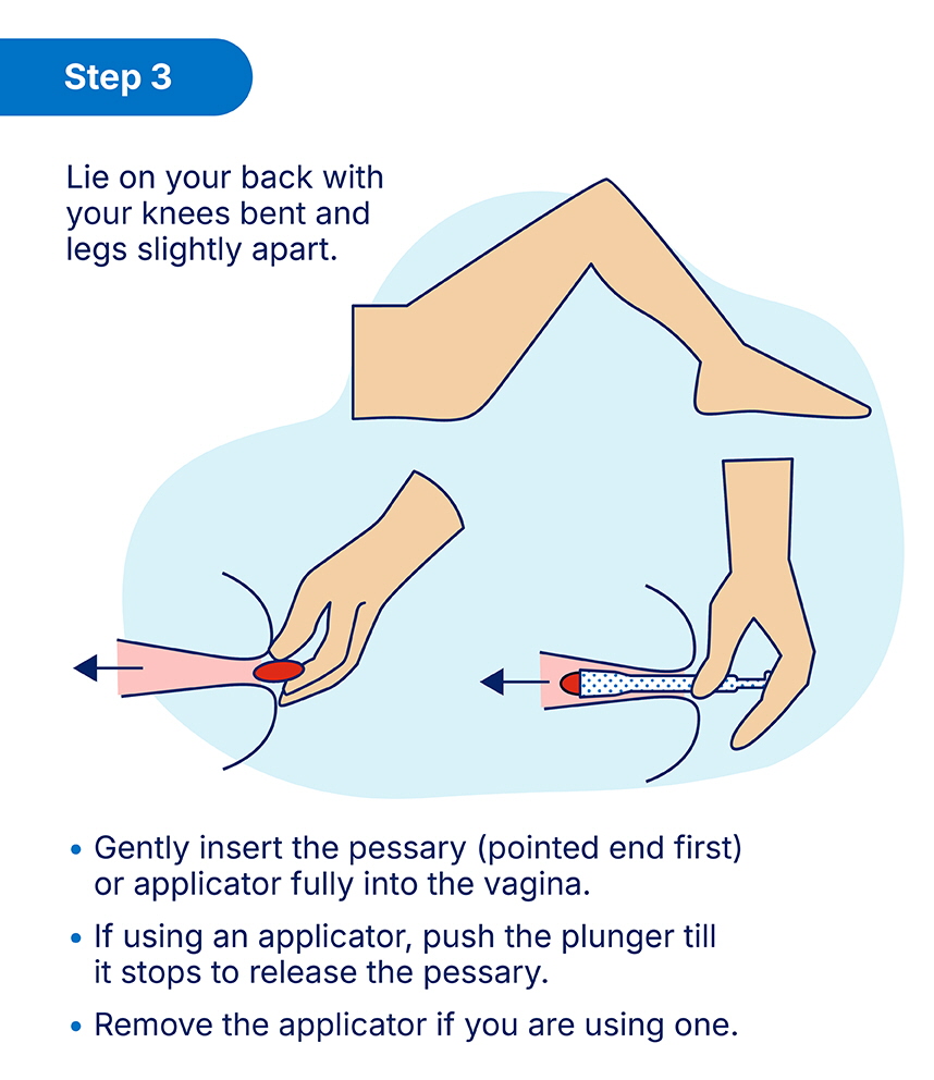 Vaginal Pessary_Output_How to VP Step 3.jpg