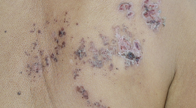 sores.jpg