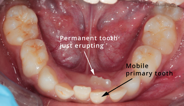 There is no need to extract a primary/baby tooth if the permanent/adult tooth is just erupting