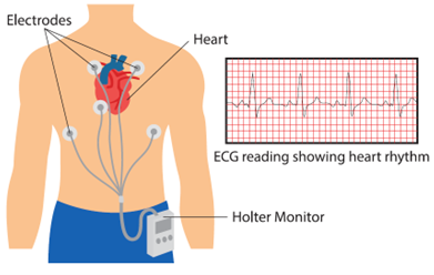 AF_P2-ECG.png