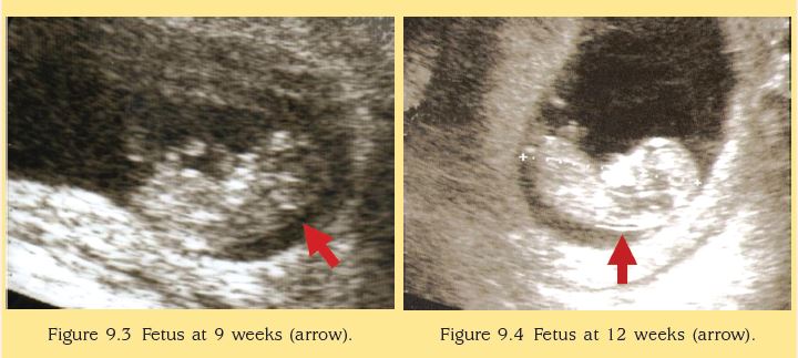 6 weeks pregnant: Symptoms, hormones, and baby development