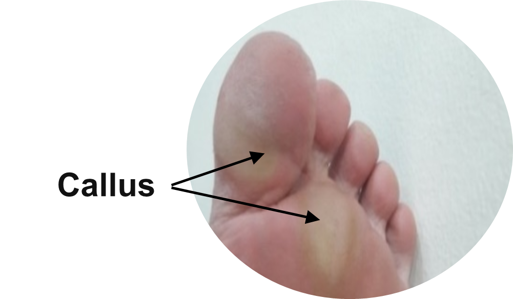 Callus.png
