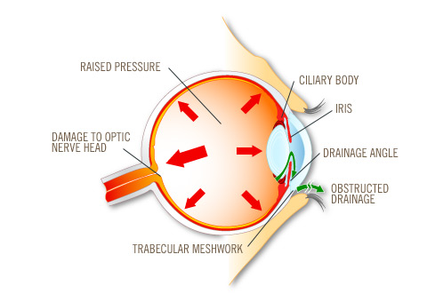 Glaucoma surgery relieves the pressure in your eyes. 