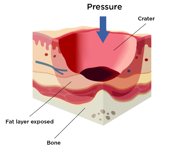 Stage 3 of pressure injury