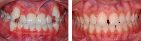 Malocclusion and Dental Braces