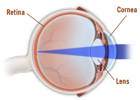 Refractive error occurs when cornea and lens are unable to focus light.