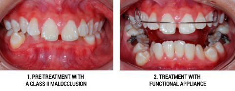 Malocclusion and Dental Braces