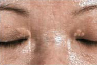 Skin conditions around the eyelids.