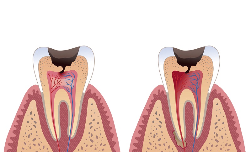 Dental Caries (Tooth Decay)