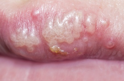 Herpes Simplex Virus (HSV) Condition, Treatments and Pictures for