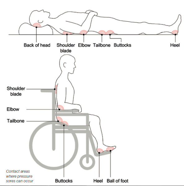 Contact areas on beds and chairs is where most pressure sores occur.