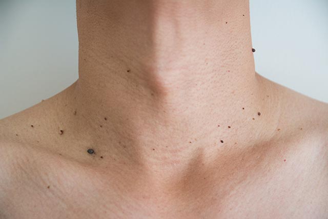 Since moles can vary in size and shape, recognising cancerous moles can be a challenge.