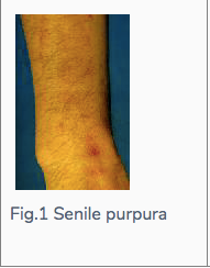 Senile purpura is a skin condition that usually appears on the forearms.