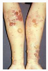 Potent medications are sometimes needed to alleviate skin problems such as bullous pemphigoid.