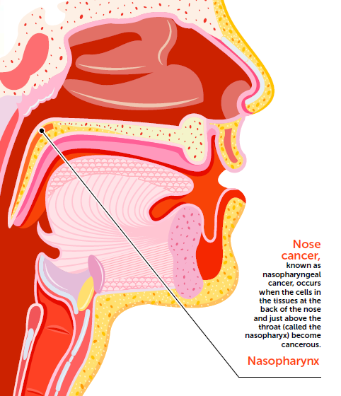 diagram explaining what nasopharyngeal cancer or nose cancer is