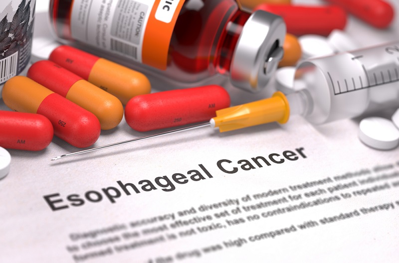 esophagealcancer.jpg