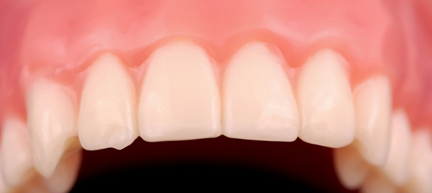 Both plaque and tartar buildup are common dental problems