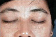 Skin growth around the eyes
