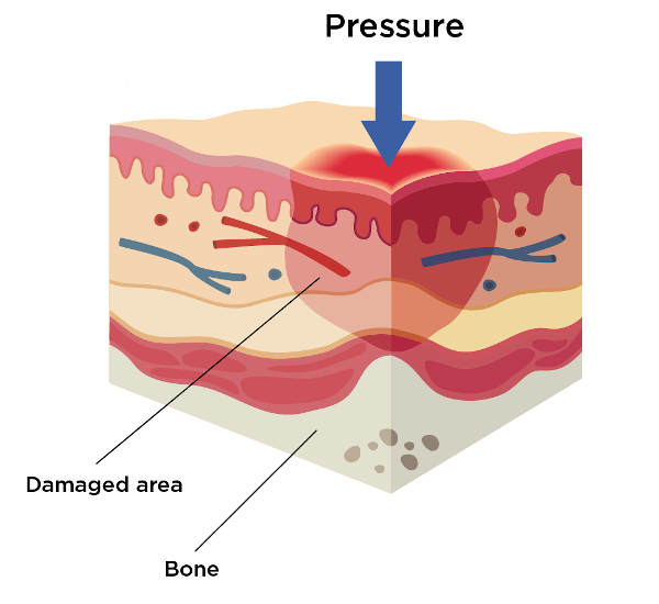 Stage 1 of pressure injury