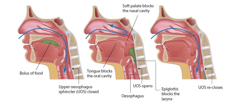 Dysphagia can cause choking