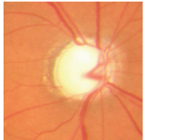 A damaged optic disc caused by glaucoma.