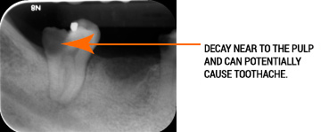 xray-of-tooth-decay