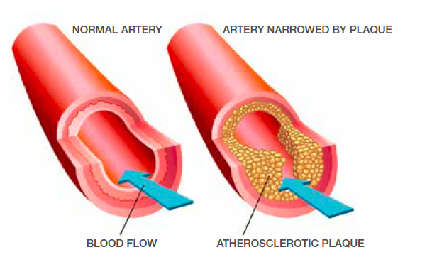 Does a blocked artery deals cause high blood pressure