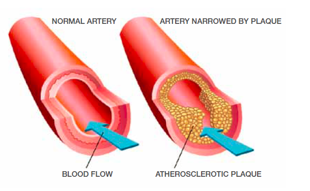 Coronary Artery Disease (CAD) develops when the arteries that supply blood to your heart become narrowed or blocked by a build-up of fatty deposits called plaque. As a result, it gets harder for the arteries to supply blood to the heart.