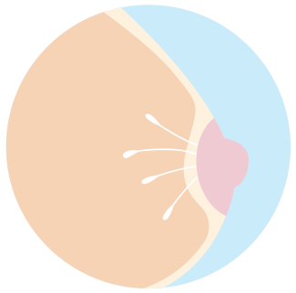 Increased risk of breast and ovarian cancers