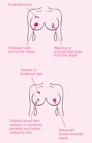 Breast cancer