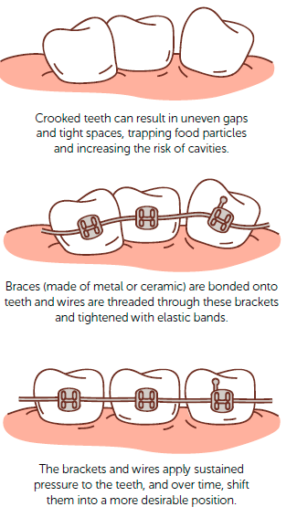 Orthodontic braces can fix uneven gaps and shift them to a desirable position.