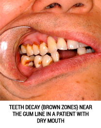 Dry mouth can cause tooth decay.