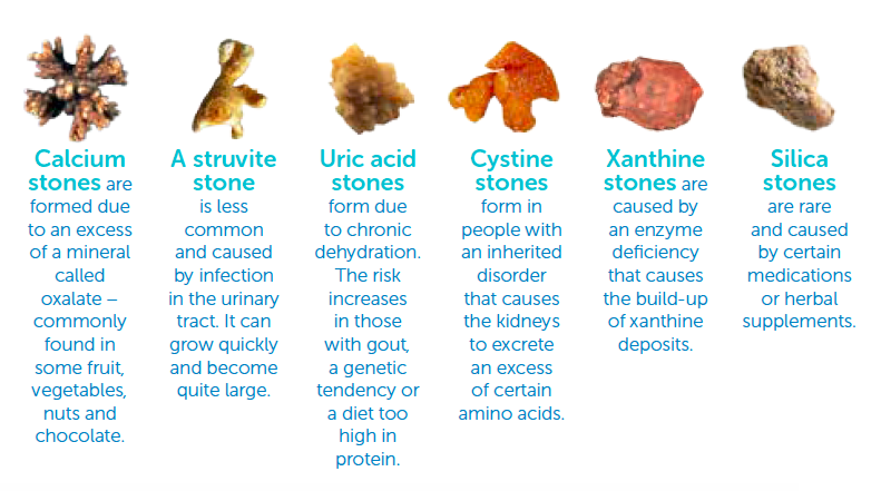 Kidney stones are made of various combinations of chemicals and are categorised as calcium-containing stones (a common form) and non-calcium containing