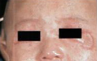 Infection around the eyes and eyelids