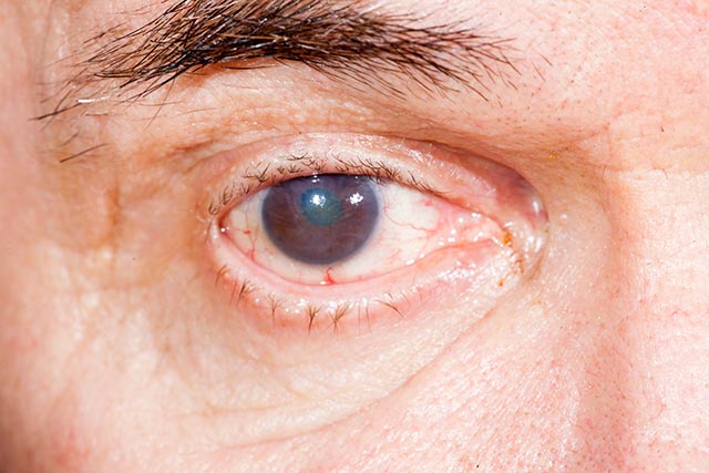 Example of cateracts in an elderly man