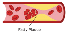 Thrombosis.png