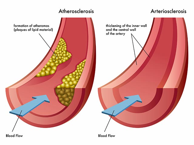 Blood flow is blocked which is a common heart disease problem