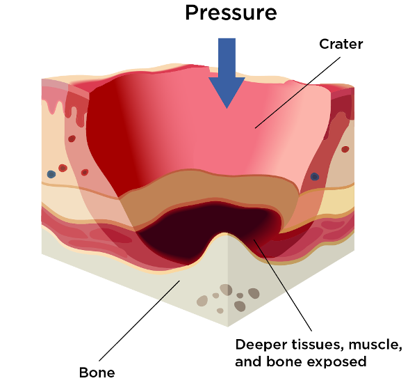 Stage 4 of pressure injury