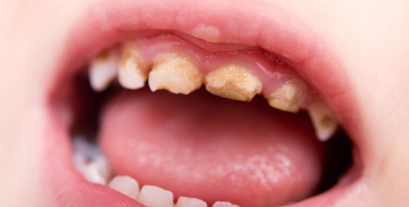 Can One Rotten Tooth Affect Others? Exploring the Connection Between Dental  Health and Overall Wellness