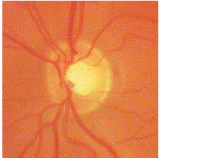 A assessment of the optic nerve determines the degree of nerve damage caused by glaucoma