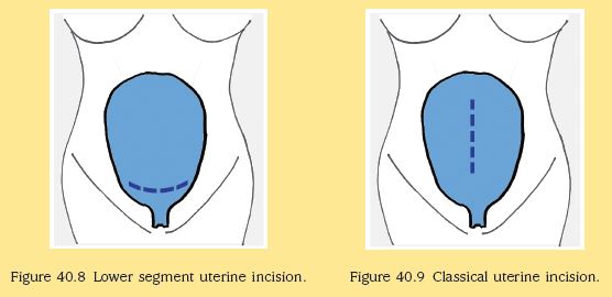 cesarean section incision types