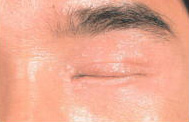Some skin conditions can be removed for cosmetic reasons