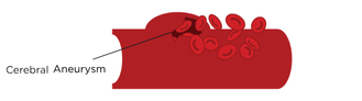 CerebralAneurysmEng.png
